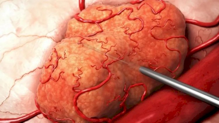 Nova radioterapia é promissora contra tumores preservando tecido saudável; entenda